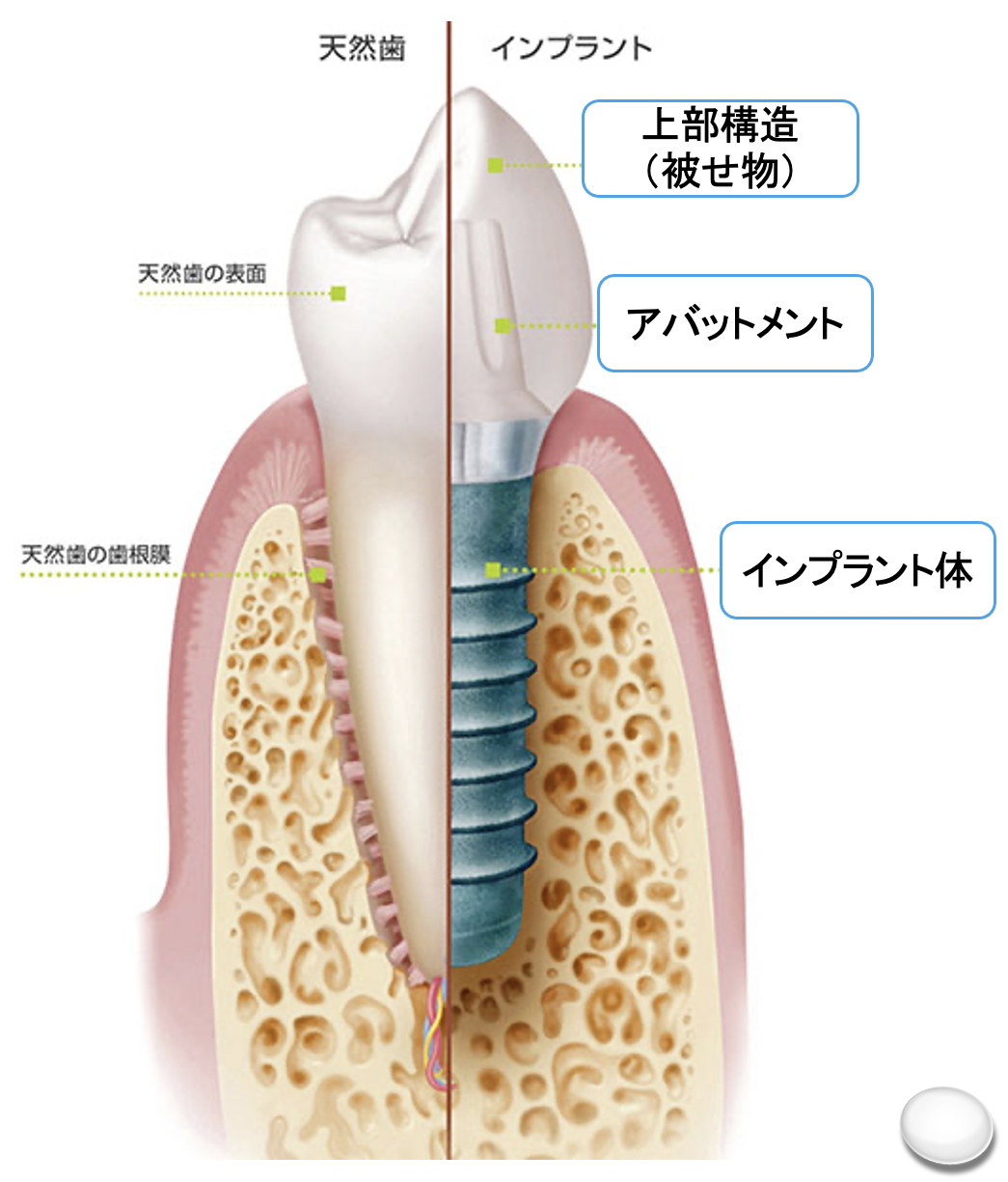 しっかり噛めることは健康への入り口！〜インプラント治療について