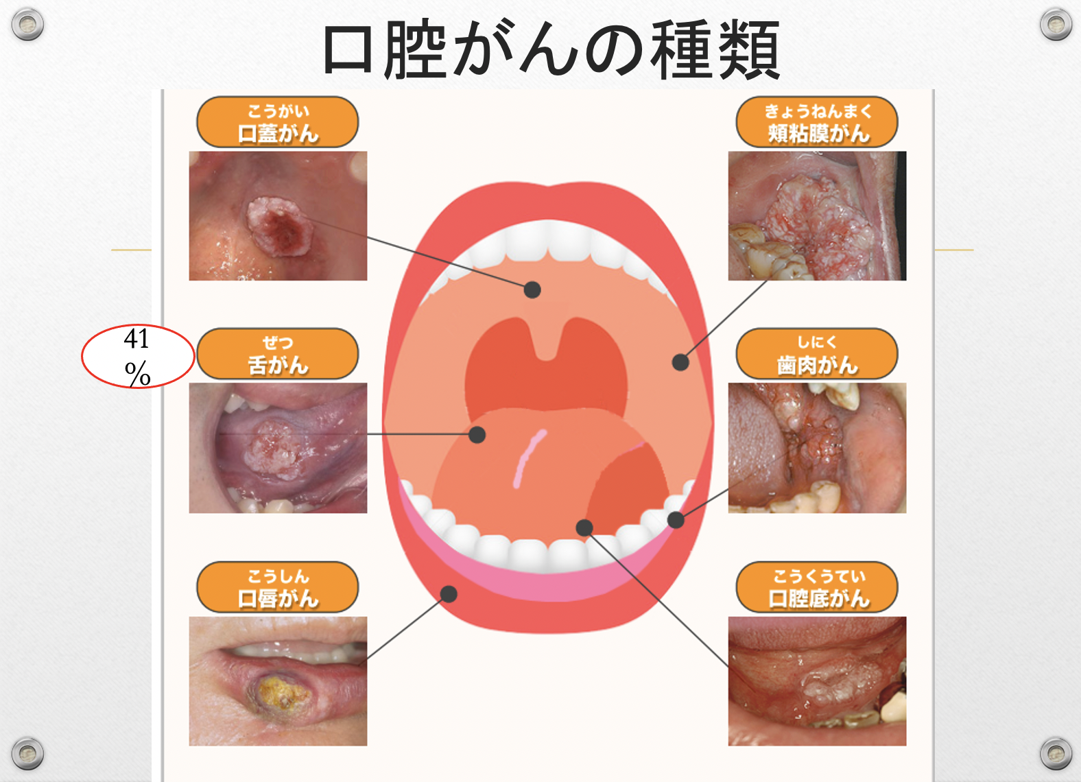 口腔 癌 口内炎 画像